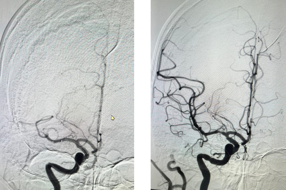 Atención en Infarto Cerebral en Ciudad de México