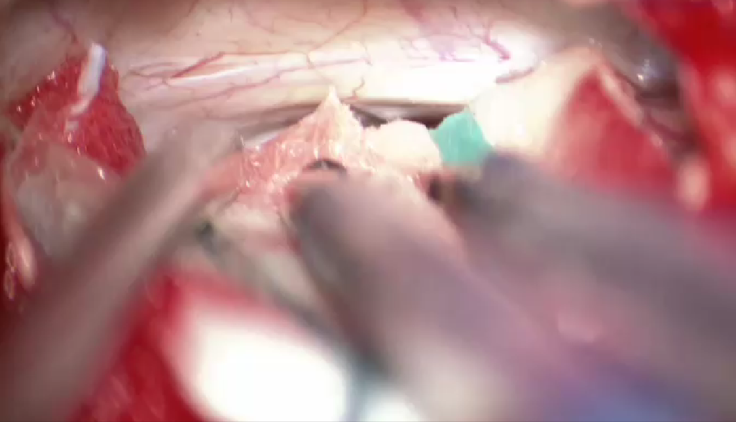 Cirugía de aneurisma cerebral