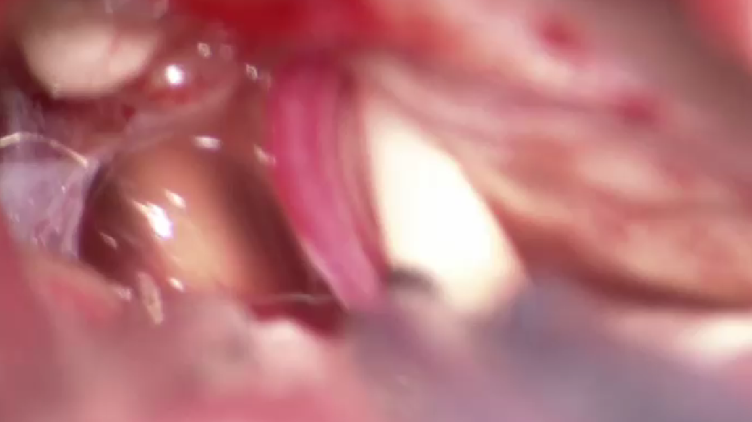 Cirugía de aneurisma cerebral