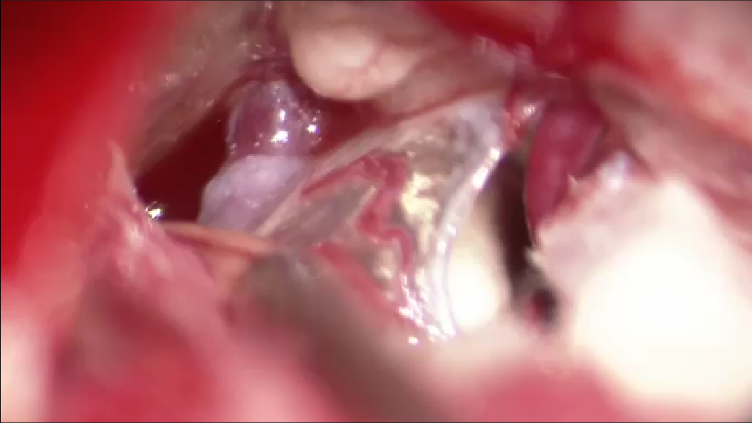 Cirugía de aneurisma cerebral