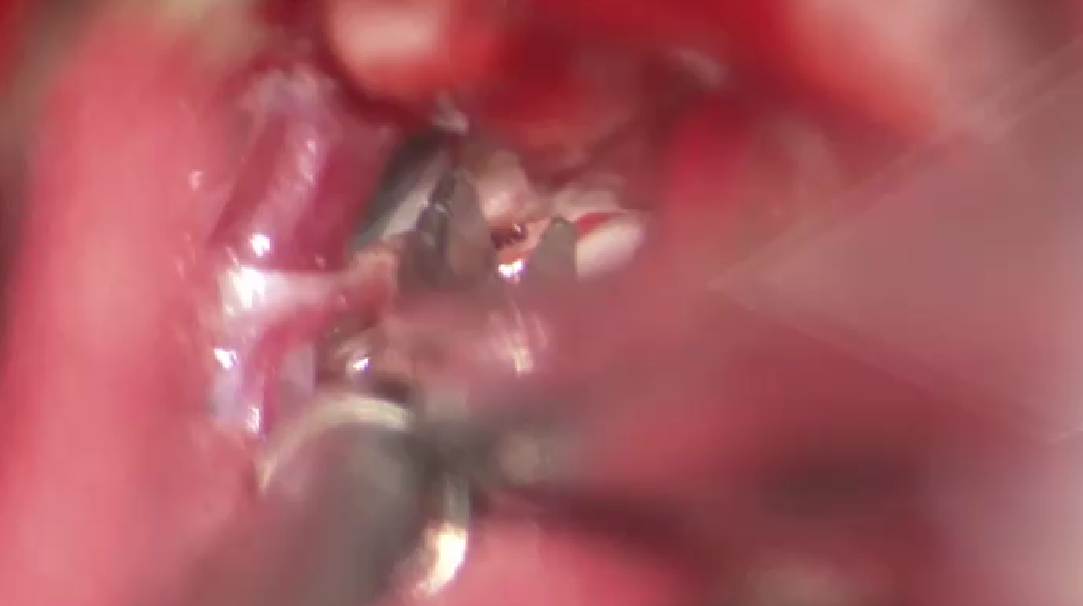 Cirugía de aneurisma cerebral