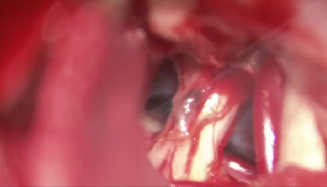 Cirugía de aneurisma cerebral